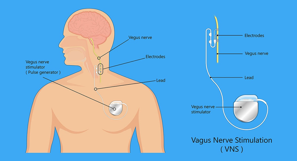 vagus nerve stimulation diagram